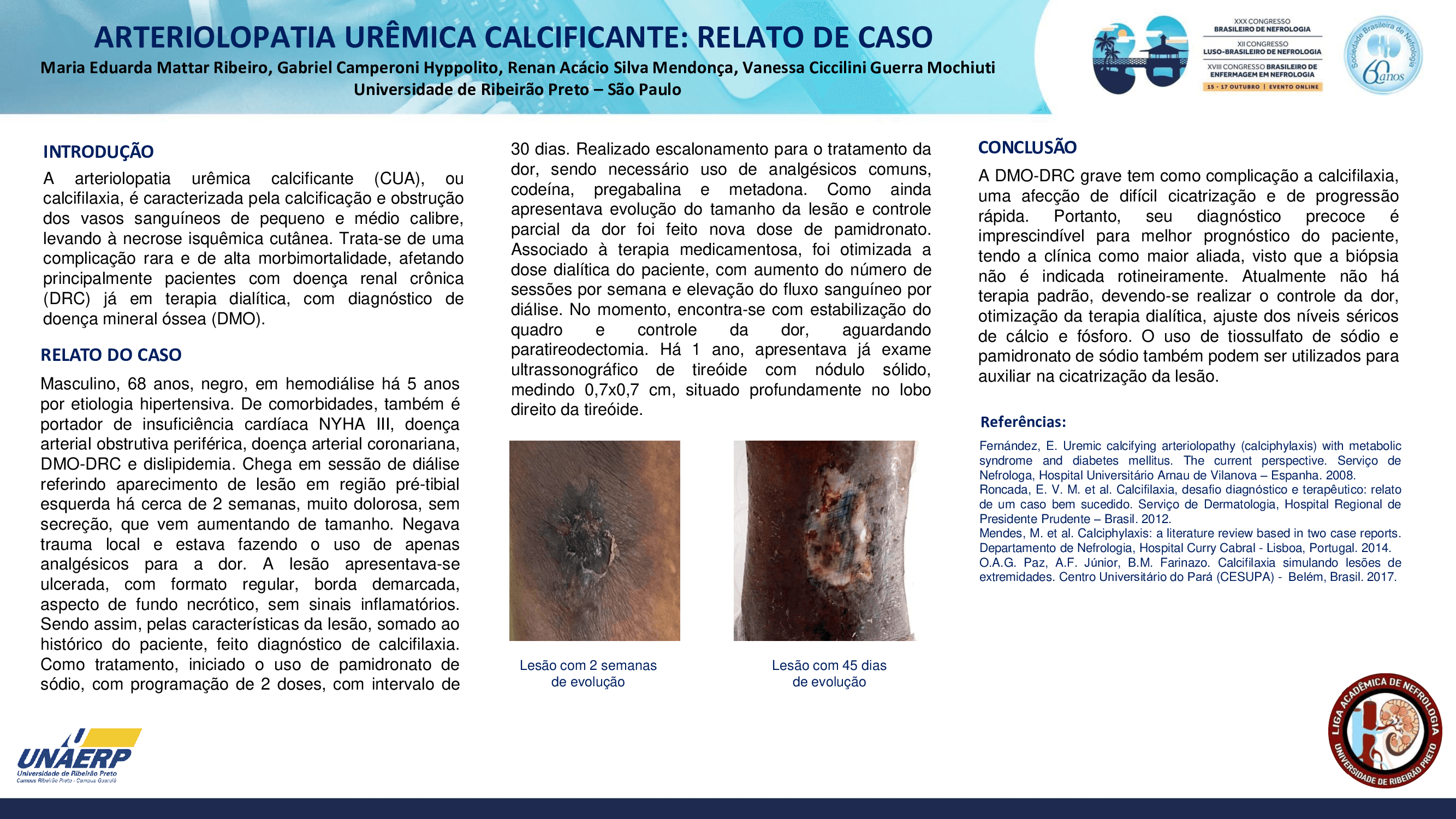 ARTERIOLOPATIA URÊMICA CALCIFICANTE: RELATO DE CASO