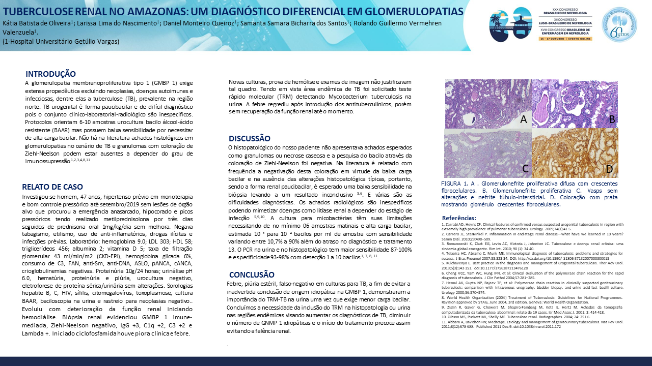 TUBERCULOSE RENAL NO AMAZONAS: UM DIAGNÓSTICO DIFERENCIAL EM GLOMERULOPATIAS.