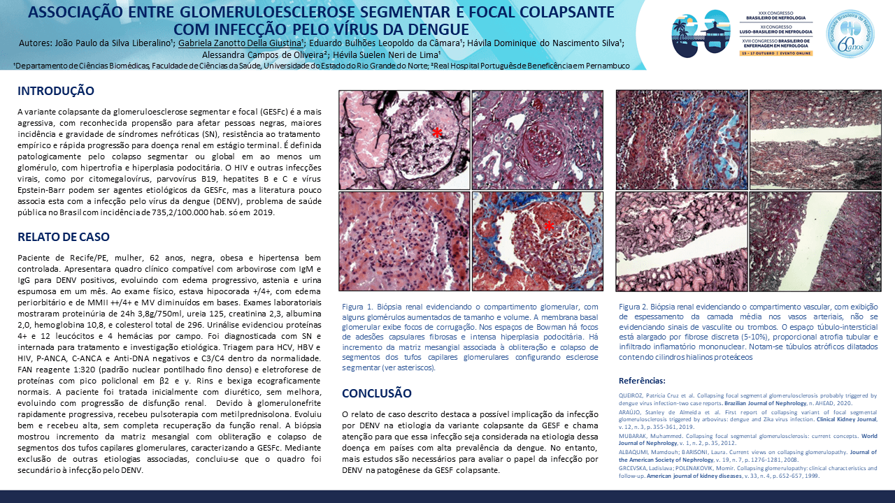 ASSOCIAÇÃO DE GLOMERULOESCLEROSE SEGMENTAR E FOCAL COLAPSANTE COM INFECÇÃO PELO VÍRUS DA DENGUE