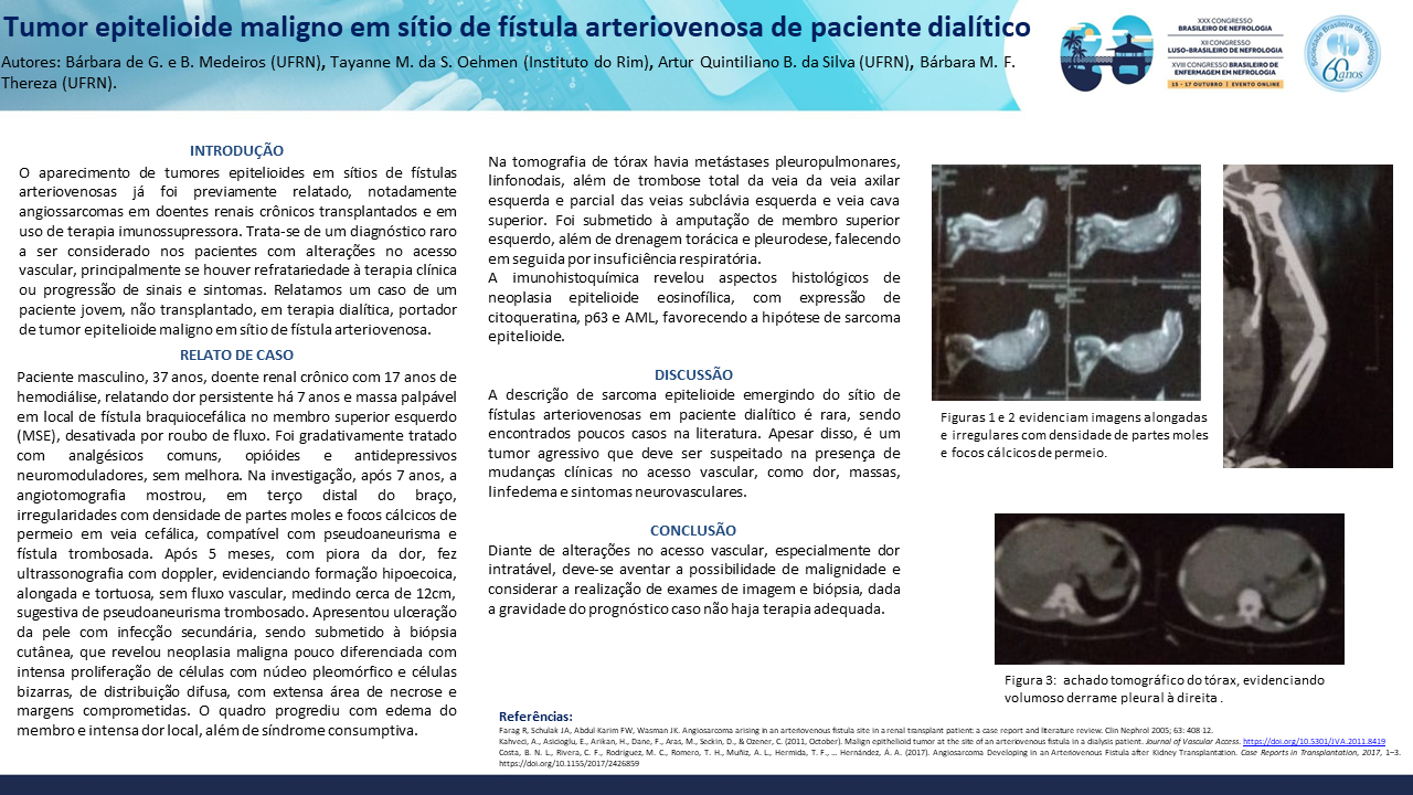 TUMOR EPITELIOIDE MALIGNO EM SÍTIO DE FÍSTULA ARTERIOVENOSA DE PACIENTE DIALÍTICO