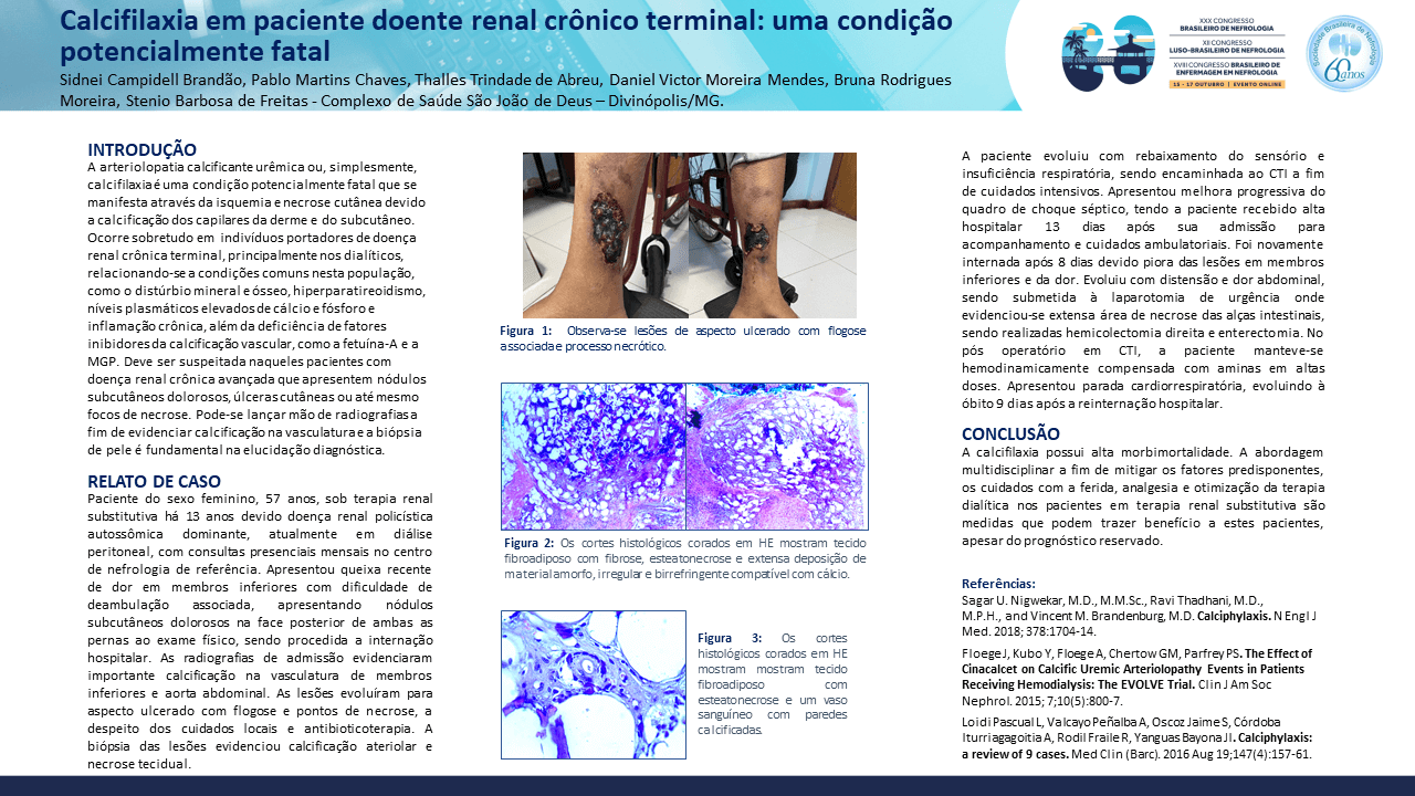 CALCIFILAXIA EM PACIENTE DOENTE RENAL CRÔNICO TERMINAL: UMA CONDIÇÃO POTENCIALMENTE FATAL.