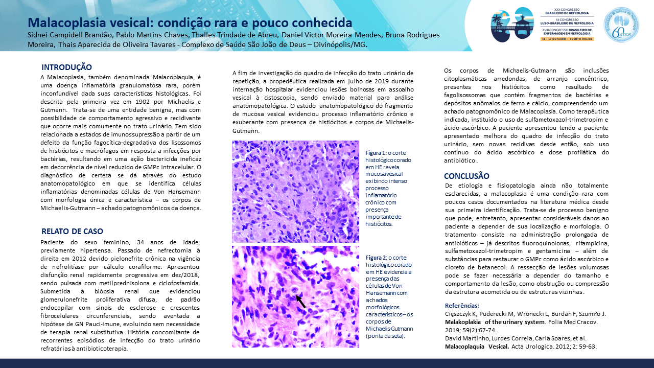 MALACOPLASIA VESICAL: UMA CONDIÇÃO RARA.