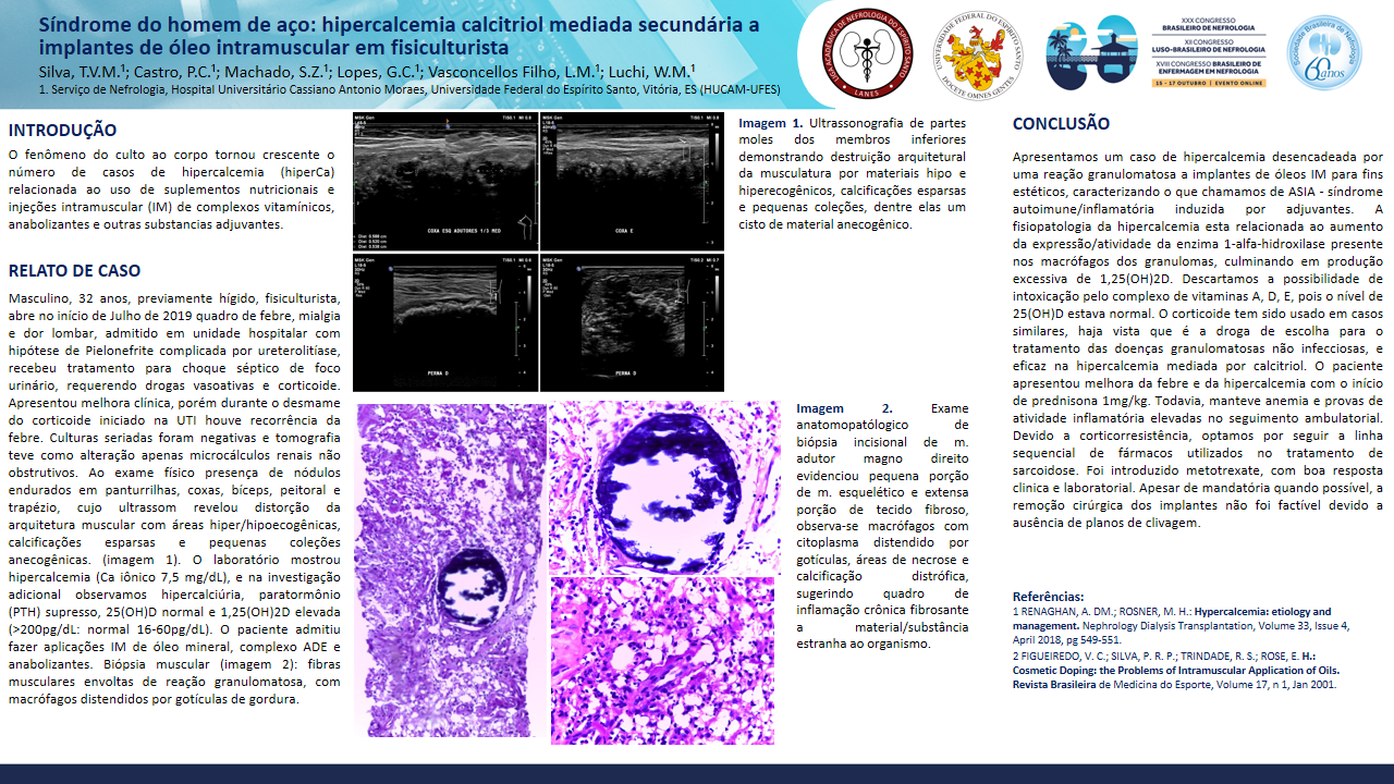 SÍNDROME DO HOMEM DE AÇO: HIPERCALCEMIA CALCITRIOL MEDIADA SECUNDÁRIA A IMPLANTES DE ÓLEO INTRAMUSCULAR EM FISICULTURISTA