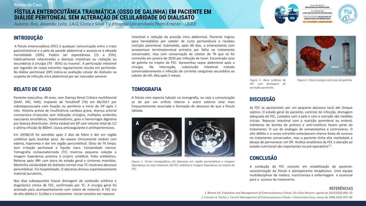 FÍSTULA ENTEROCUTÂNEA TRAUMÁTICA (OSSO DE GALINHA) EM PACIENTE EM DIÁLISE PERITONEAL SEM ALTERAÇÃO DE CELULARIDADE DO DIALISATO.