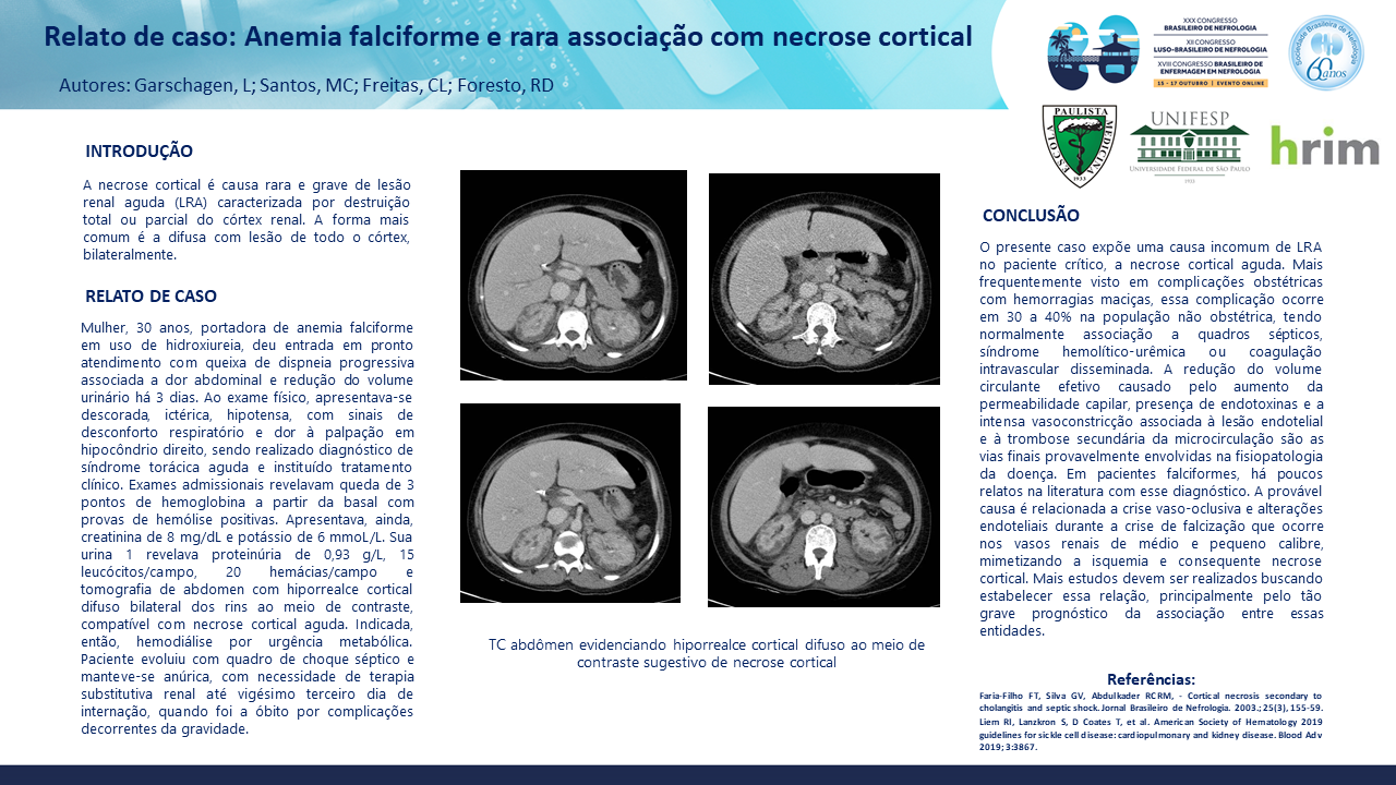 ANEMIA FALCIFORME E RARA ASSOCIAÇÃO COM NECROSE CORTICAL