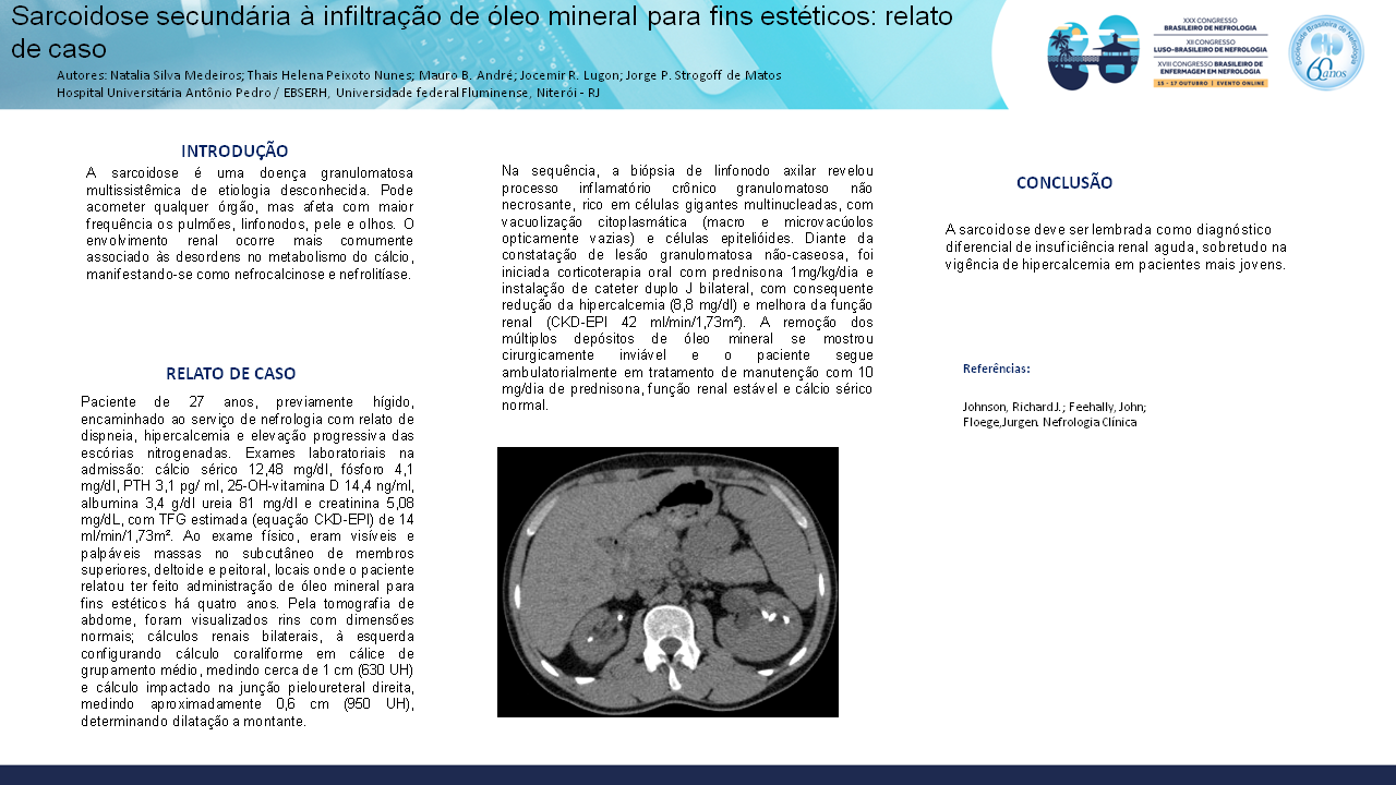 SARCOIDOSE SECUNDÁRIA À INFILTRAÇÃO DE ÓLEO MINERAL PARA FINS ESTÉTICOS: RELATO DE CASO