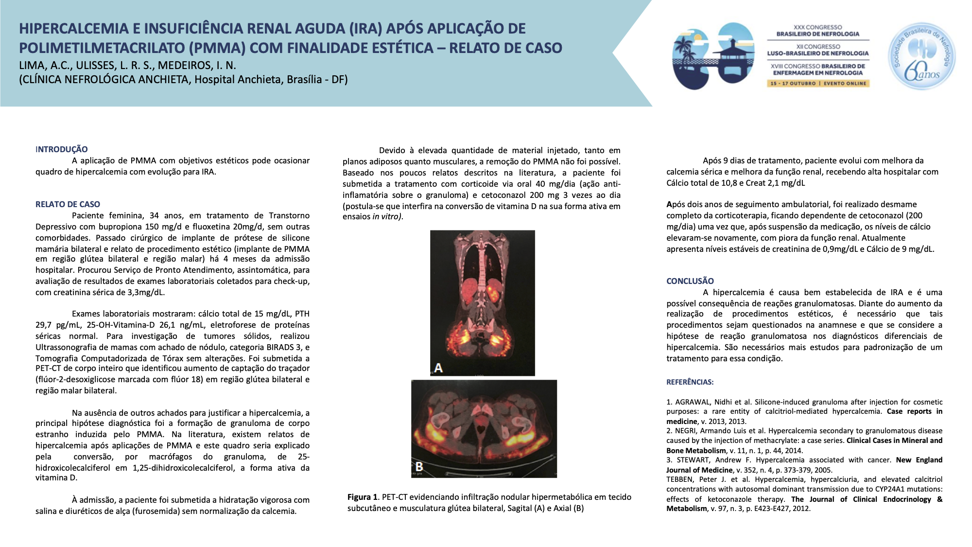 HIPERCALCEMIA E INSUFICIÊNCIA RENAL AGUDA (IRA) APÓS APLICAÇÃO DE POLIMETILMETACRILATO (PMMA) COM FINALIDADE ESTÉTICA