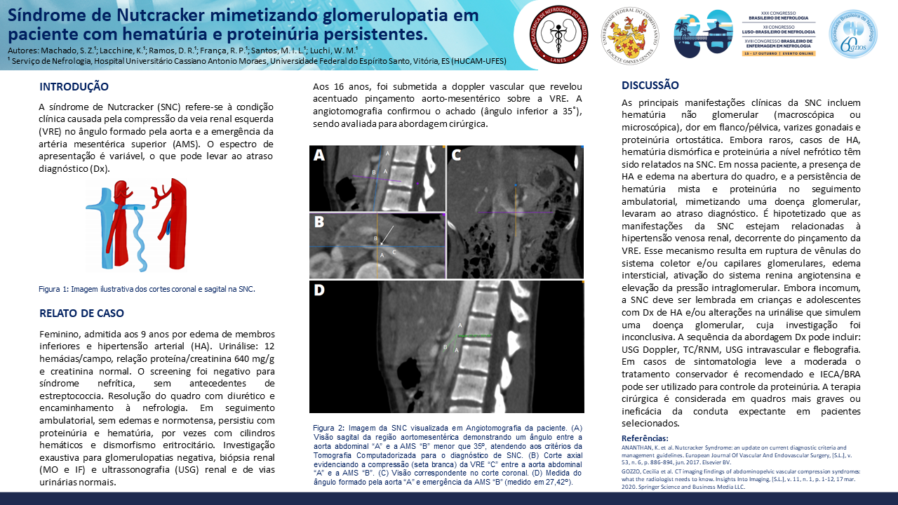 SÍNDROME DE NUTCRACKER MIMETIZANDO GLOMERULOPATIA EM PACIENTE COM HEMATÚRIA E PROTEINÚRIA PERSISTENTES