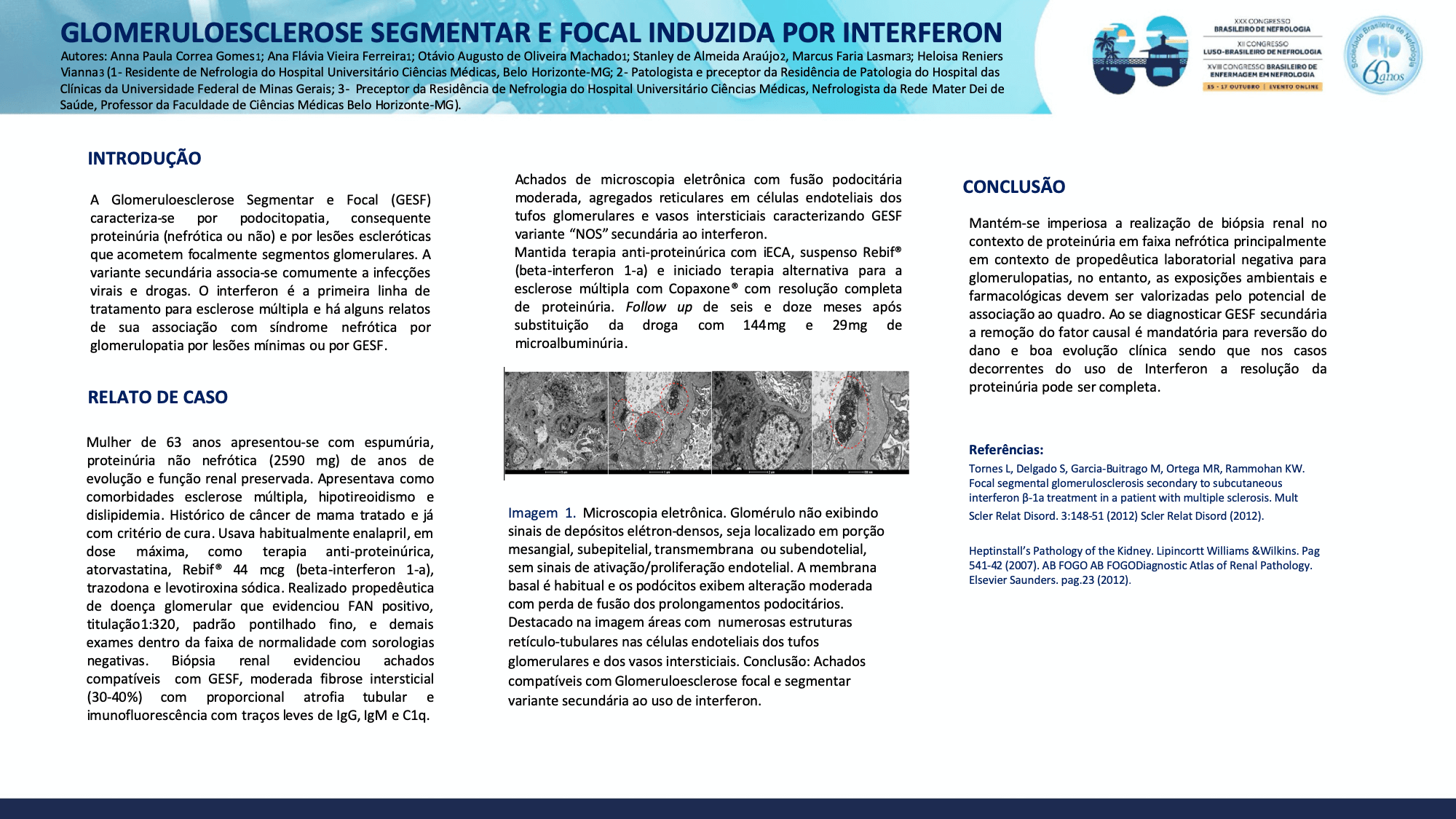 GLOMERULOESCLEROSE SEGMENTAR E FOCAL INDUZIDA POR INTERFERON