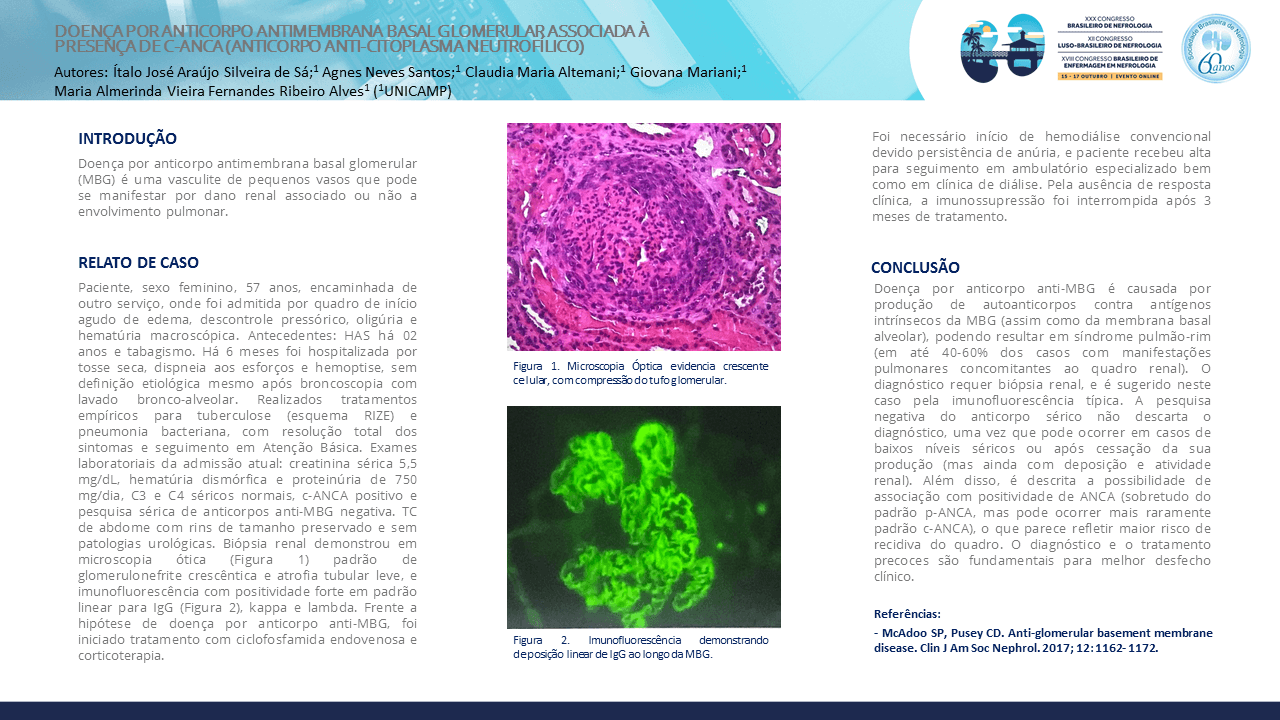 DOENÇA POR ANTICORPO ANTIMEMBRANA BASAL GLOMERULAR ASSOCIADA À PRESENÇA DE C-ANCA (ANTICORPO ANTI-CITOPLASMA NEUTROFÍLICO)