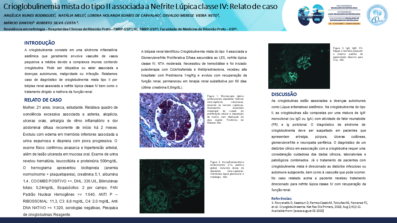 CRIOGLOBULINEMIA MISTA DO TIPO II ASSOCIADA NEFRITE LÚPICA CLASSE IV