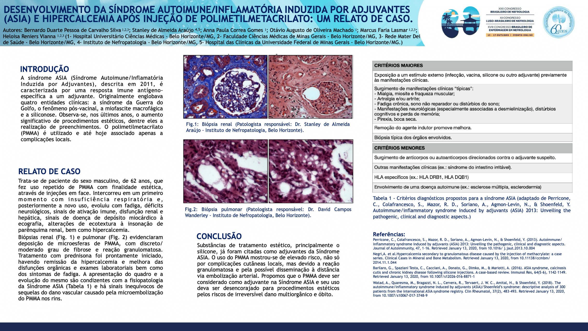 DESENVOLVIMENTO DA SÍNDROME AUTOIMUNE/INFLAMATÓRIA INDUZIDA POR ADJUVANTES (ASIA) E HIPERCALCEMIA APÓS INJEÇÃO DE POLIMETILMETACRILATO: UM RELATO DE CASO.